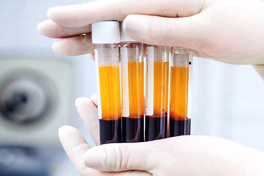 PRP(Platelet Rich Plasma)